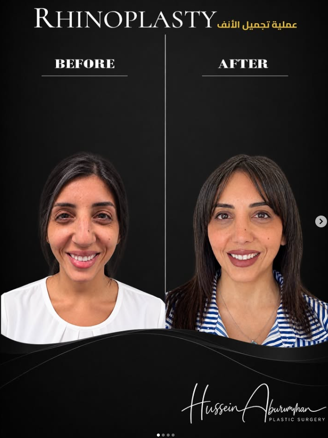 عملية تجميل الانف
